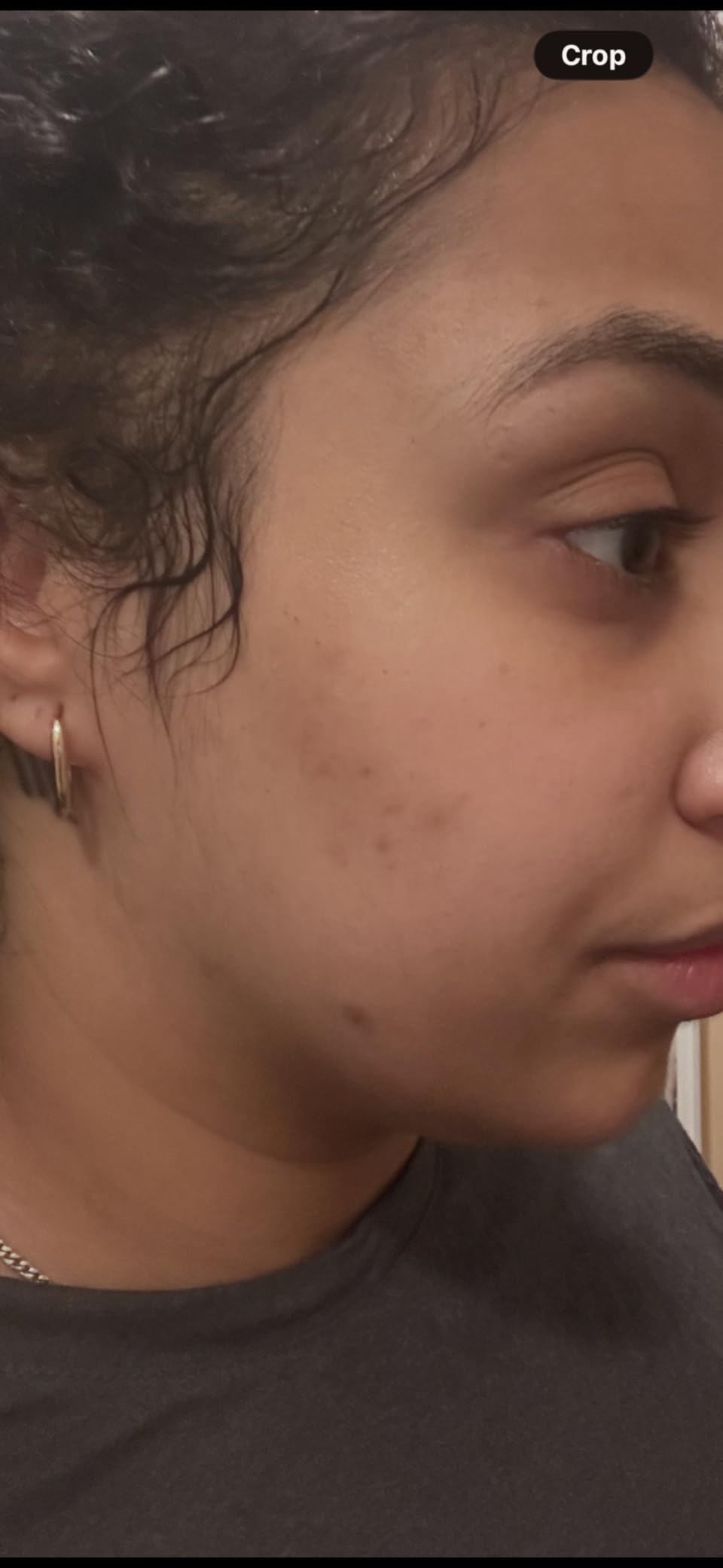 DR LEO | Combate el acne