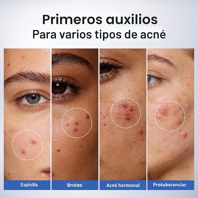 DR LEO | Combate el acne